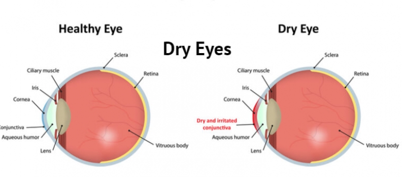 Treatment Of Dry Eyes – Follow Some Useful Home Remedies